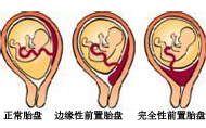 前置胎盤分哪幾種？有什么癥狀？